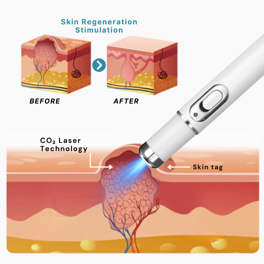 Non-Invasive Mole and Wart Removal Laser Pen PRO