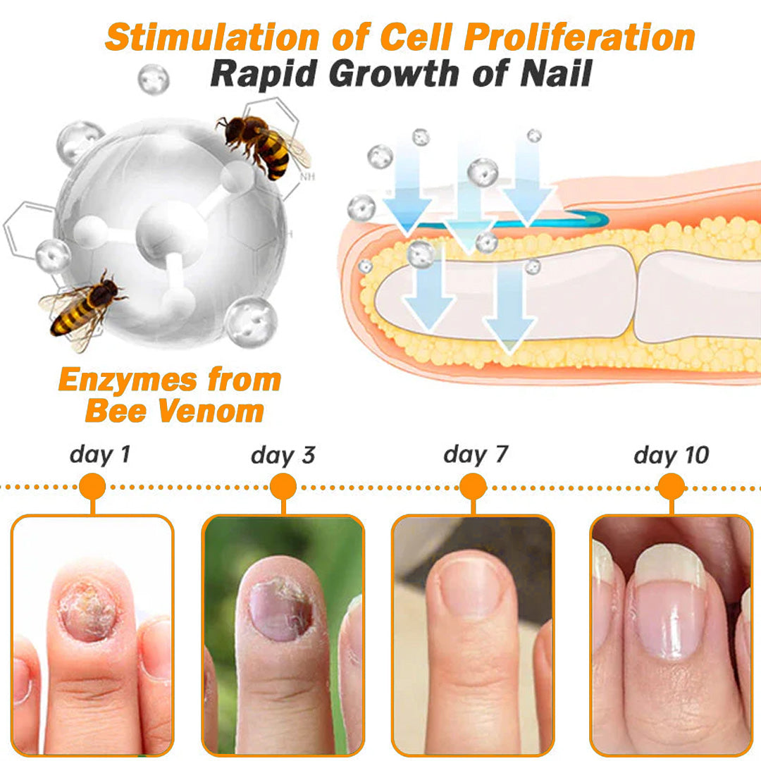 💥2025 Limited 70% OFF⏳ Kolirin Bee Venom Nail Fungus Treatment Cream