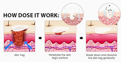 ✅Official Store: Magnesium MicroPin Target & Clear Wart Removal Patch