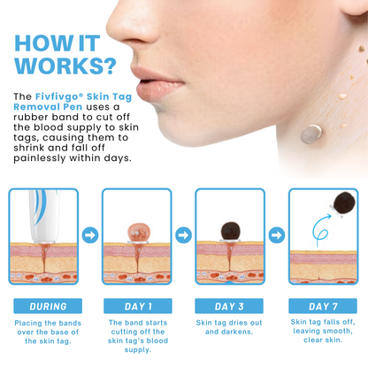 Painless At-home Skin Tag Removal Pen