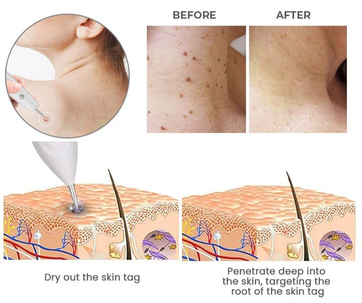 Advanced Plasma Laser Spot Cleaning Pen