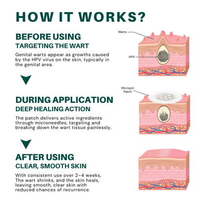 Magnesium MicroPin HPV Genital Wart Removal Patch