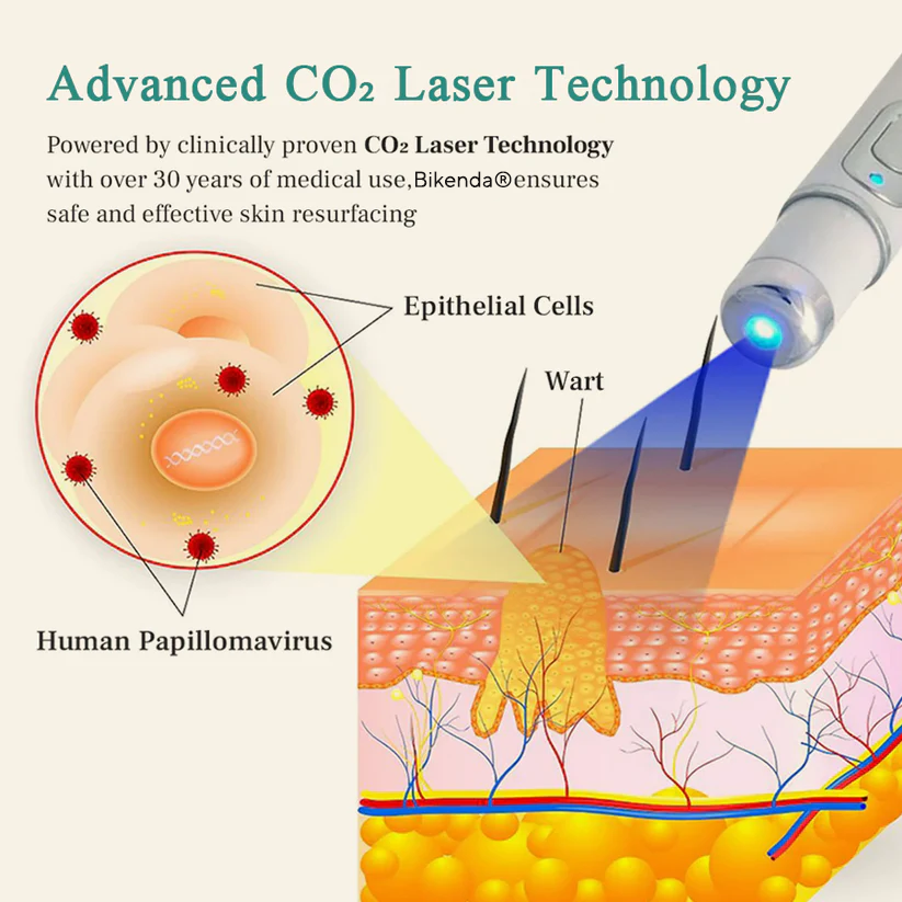 HPV Genital Warts Removal Laser Pen