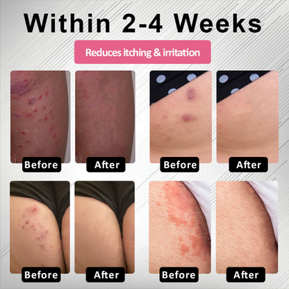 Female HPV Genital Wart Caring Spray