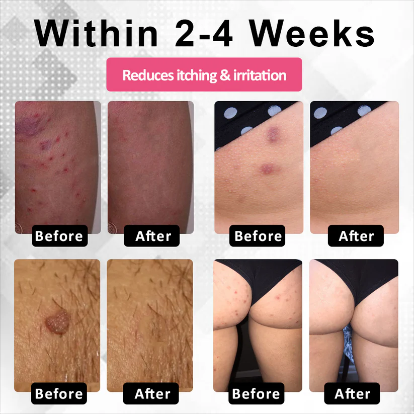 Woman's Genital HPV Healing Cream