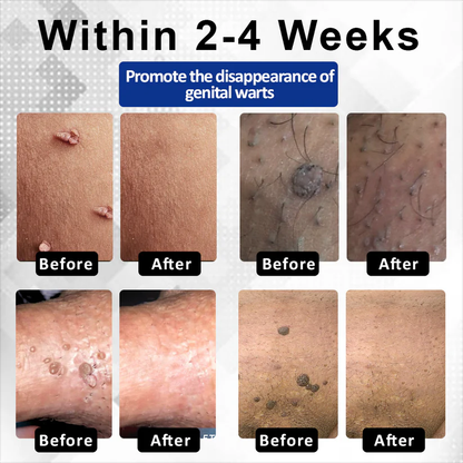 ManGuard HPV WART Healing Cream