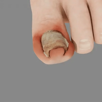 💥 2025 Limited 70% OFF ️⏳  Kolirin Bee Venom Nail Fungus Spray 💥 Fix All Nail Problems within 2 Weeks