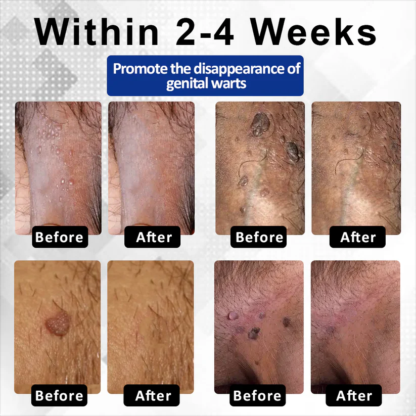 ManGuard HPV WART Healing Cream