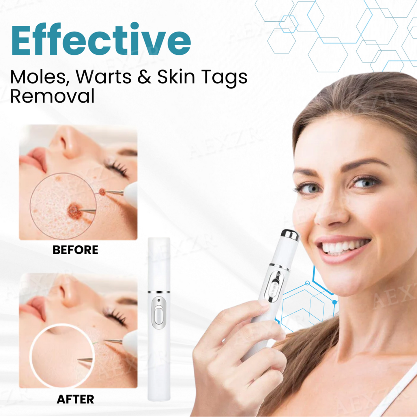 Non-Invasive Mole and Wart Removal Laser Pen PRO