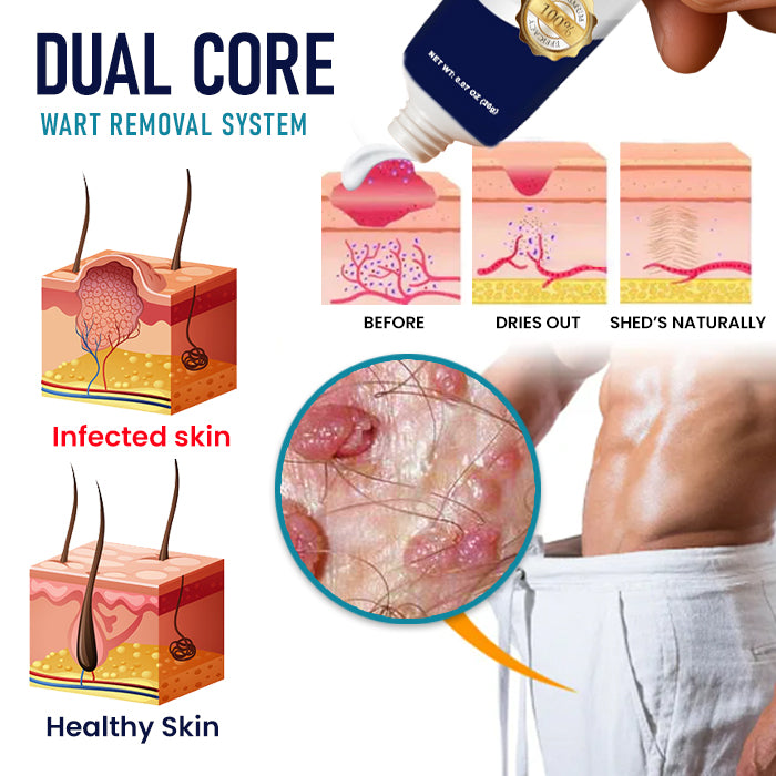 Genital Warts Remover Cream 👨Designed for Men