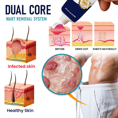 Genital Warts Remover Cream 👨Designed for Men