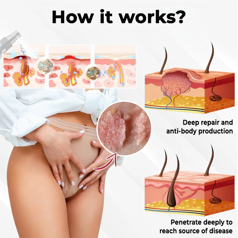 Female HPV Genital Wart Caring Spray