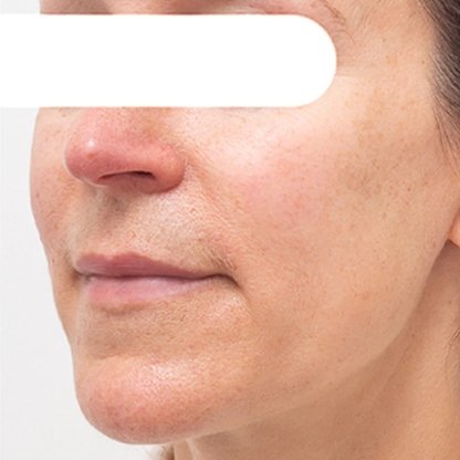 Herbal Spots Peel-Off Facial Mask PRO