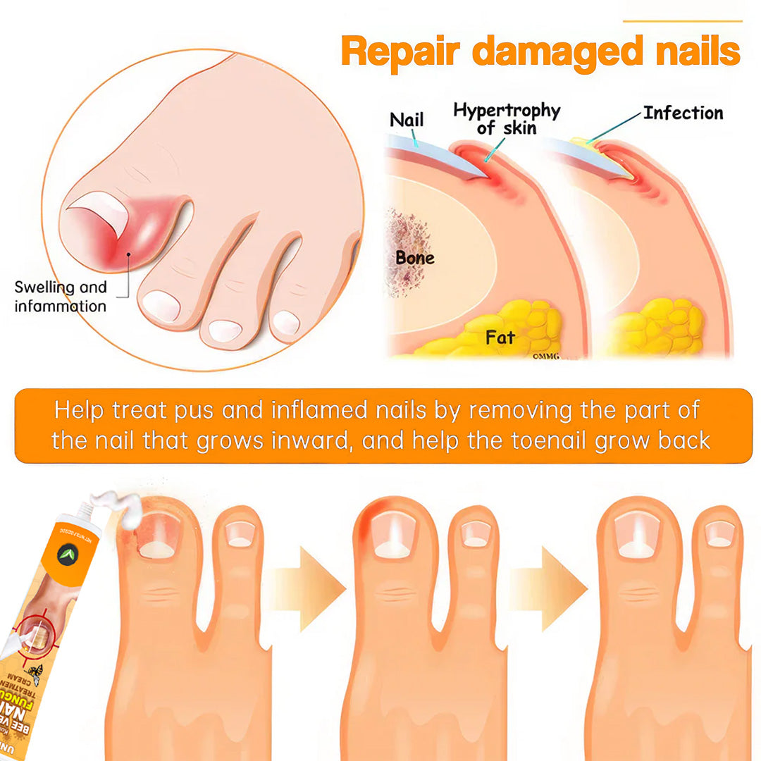 💥2025 Limited 70% OFF⏳ Kolirin Bee Venom Nail Fungus Treatment Cream