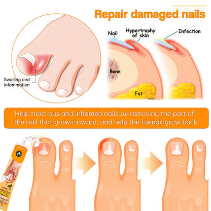 💥2025 Limited 70% OFF⏳ Kolirin Bee Venom Nail Fungus Treatment Cream