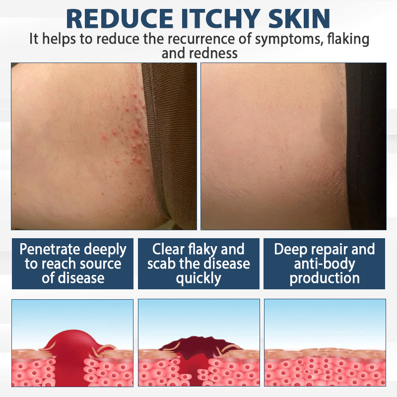 LicorRelief Man Genital Antifungal Cream