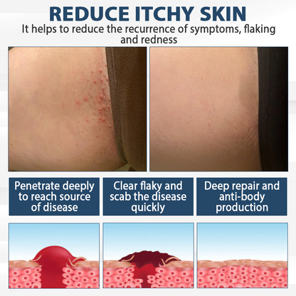 LicorRelief Man Genital Antifungal Cream