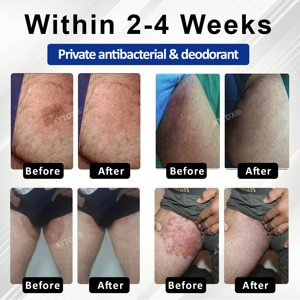 LicorRelief Man Genital Antifungal Cream