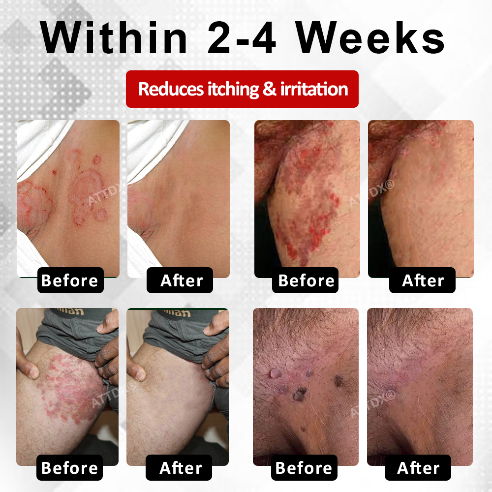 Men's HPV Warts Care Spray