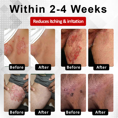 Men's HPV Warts Care Spray