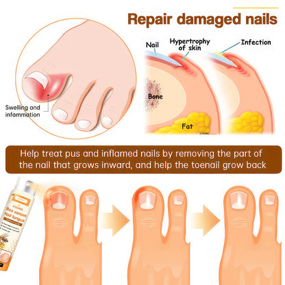 💥 2025 Limited 70% OFF ️⏳  Kolirin Bee Venom Nail Fungus Spray 💥 Fix All Nail Problems within 2 Weeks