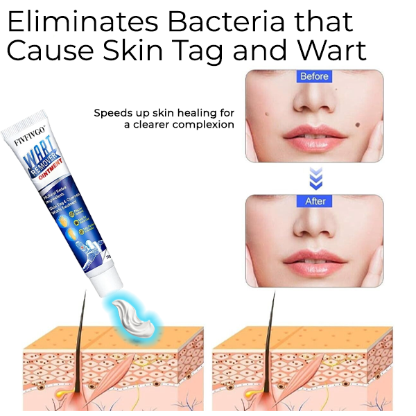 Mole and Wart Removal Laser Set