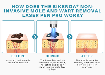 Non-Invasive Mole and Wart Removal Laser Pen PRO