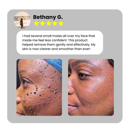 Home Use CO2 Laser Shot Erase Pro