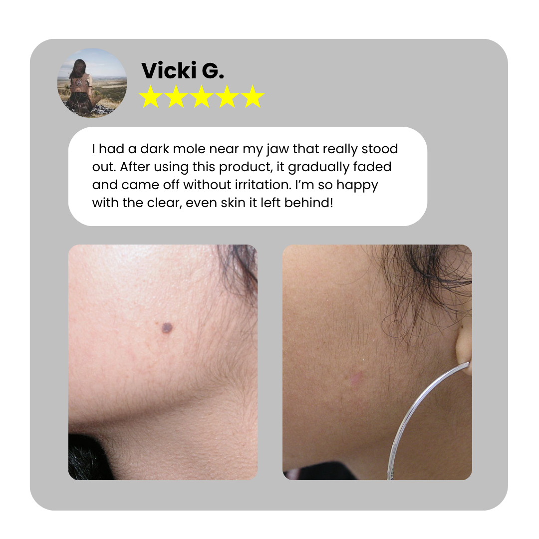 Home Use CO2 Laser Shot Erase Pro