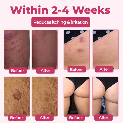 ♀️Woman's Genital HPV Relief Cream 🔥HOT SALE UP TO 60% OFF