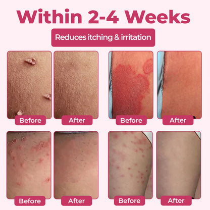 ♀️Woman's Genital HPV Relief Cream 🔥HOT SALE UP TO 60% OFF